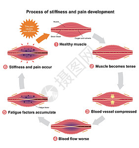肌肉僵硬和疼痛圆圈类型它制作图案的过程插图肩膀器官痛苦身体组织脖子生物学纤维药品插画