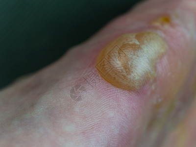 从步行的大型大水泡医疗细菌伤口湿疹痛苦治疗伤害男性痘痘感染背景图片