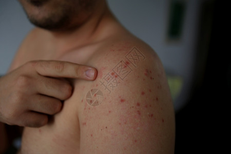 麻疹感染皮疹麻疹疾病皮肤科危险过敏治疗风疹疫苗红色背景图片