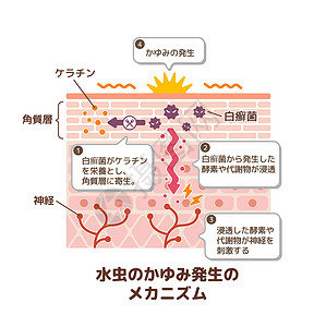 脚癣病媒制作图案的产生机制医院卫生身体治疗肿胀角质层伤口地层手指皮疹设计图片