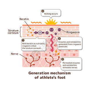 脚癣病媒制作图案的产生机制感染肿胀手指疾病皮肤痛苦治疗皮炎保健角质层设计图片