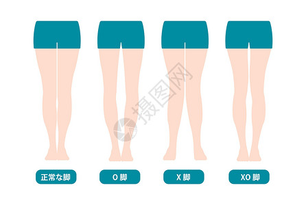 胫骨内翻弓腿关节腔高清图片