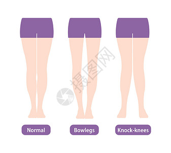 膝外翻不同类型的腿部角度和膝盖矢量图解 正常保龄球腿外翻保健身体疼痛膝关节炎脚骨平衡治疗骨科外科股骨设计图片