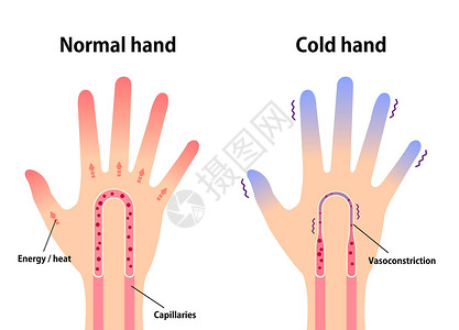 疼痛图正常手和冷手对指尖冷的敏感度比较图卡通片手指血液循环蓝色女性状况疼痛疾病流感成人设计图片