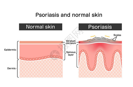 皮肤横截面牛皮癣和正常皮肤平面矢量图案的横截面牌匾过敏斑块皮炎治疗科学疼痛荨麻疹真皮表皮设计图片