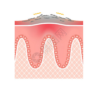皮肤结果牛皮癣皮肤扁平载体它制作图案的横截面症状药品疼痛细胞皮肤科身体治疗牌匾斑块表皮插画