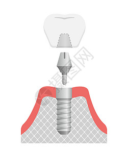颚牙科植入物平面矢量图 No tex手术外科陶瓷诊所牙医解剖学磨牙假牙横截面插图插画