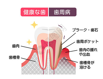 牙周疾病正常牙齿和牙周病的比较 平面矢量图清洁度口腔医疗插图牌匾牙医本质感染疾病搪瓷插画