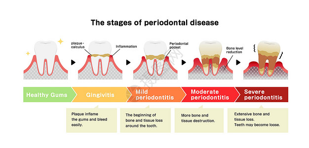 牙周疾病牙周炎病媒它制作图案的阶段牙齿口服疾病插图保健口腔横截面清洁度牙疼医疗插画