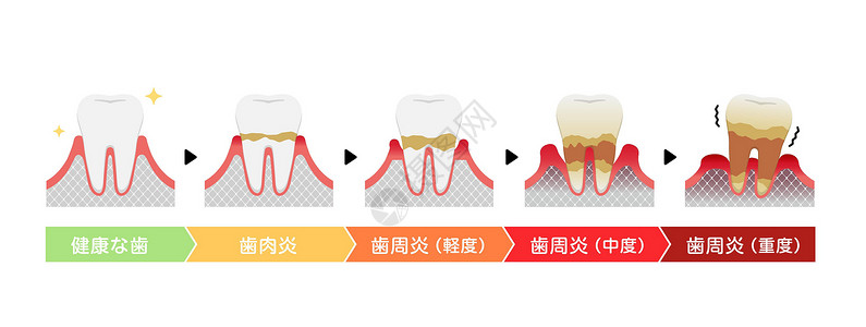 牙本质牙周炎病媒它制作图案的阶段保健口臭治疗牙疼本质口腔插图横截面细菌疼痛插画
