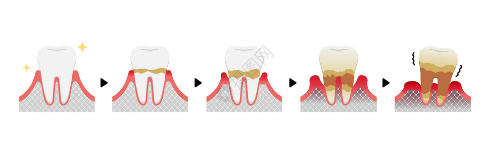 嘴喙牙周炎病媒它制作图案的阶段插图疾病护理清洁度医疗口臭细菌牙齿横截面口服插画