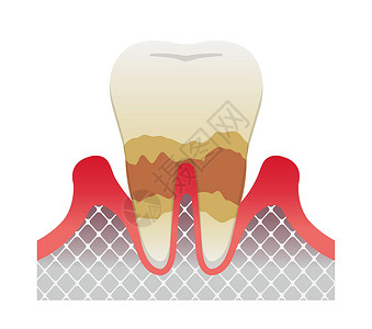 牙周炎疾病的阶段 中度牙周炎插画