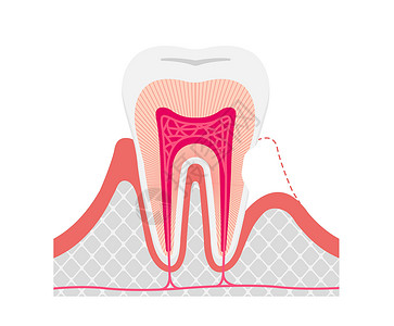 牙齿敏感矢量图解无 tex 的原因和机制插画