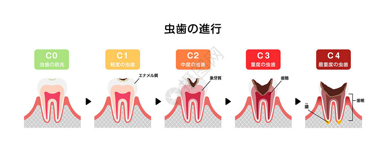 牙本质日本蛀牙平面矢量图解的各个阶段诊所本质搪瓷插图牙齿疾病脓肿保健疼痛牙疼设计图片