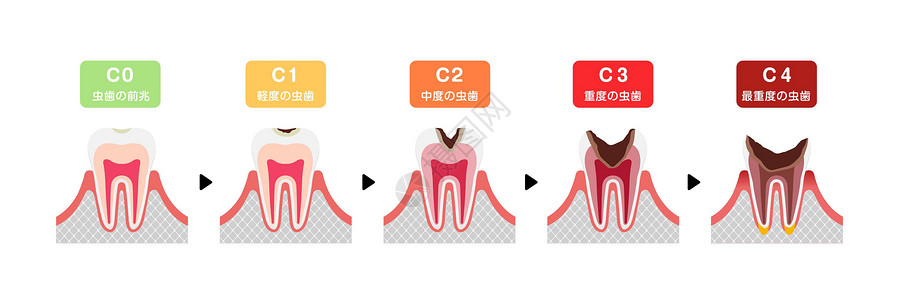 牙本质日本蛀牙平面矢量图解的各个阶段感染磨牙信息诊所王冠衰变搪瓷健康牙医脓肿设计图片