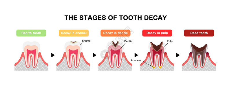 牙本质蛀牙平面向量它制作图案的阶段插图衰变保健诊所卫生脓肿磨牙牙医治疗健康设计图片