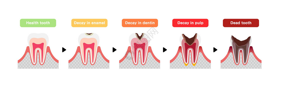 牙齿颜色蛀牙平面向量它制作图案的阶段磨牙疾病解剖学图表脓肿搪瓷衰变空腔卡通片卫生设计图片