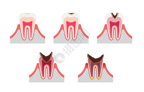 牙本质蛀牙平面矢量图解 se 的阶段设计图片