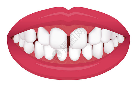 深覆合牙齿问题咬合型歪牙矢量图解过度 Spacin插画