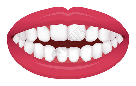 反嘴鹬牙齿问题咬合型歪牙矢量图解开式钻头插画