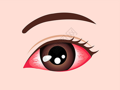 发痒的结膜炎粉红眼病媒它制作图案插画