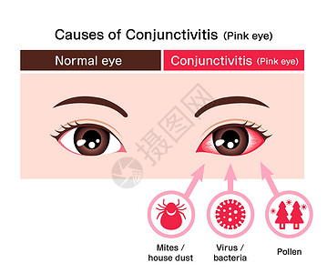 红眼病它制作图案的结膜炎粉红色眼病媒的成因眼球流感血丝医生症状细菌结膜疾病感染过敏插画