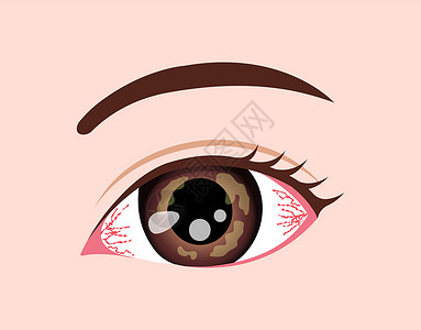 眼部疾病矢量图 疱疹性角膜炎背景图片