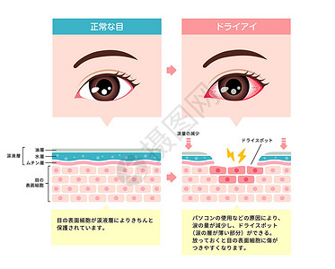 眼干眼涩正常眼和干眼的比较图 眼睛表面的横截面 日本人案头药店眼科眼球过敏瞳孔青光眼药品办公室工人插画