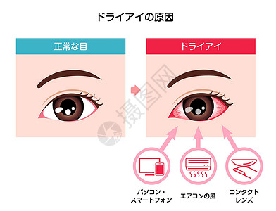 日本干眼症病媒图解的成因眼球工作疼痛眼泪液体眼科镜片治疗案头青光眼插画