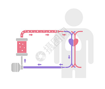 血氧交换ECMO体外膜氧合结构矢量图无tex插画