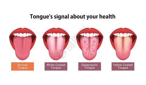舌头健康标志矢量图白色涂层舌头口臭卫生画眉感染病人药品女士细菌治疗念珠菌背景图片