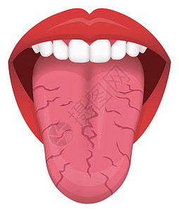 舌头疾病舌头健康标志矢量图裂纹舌插画