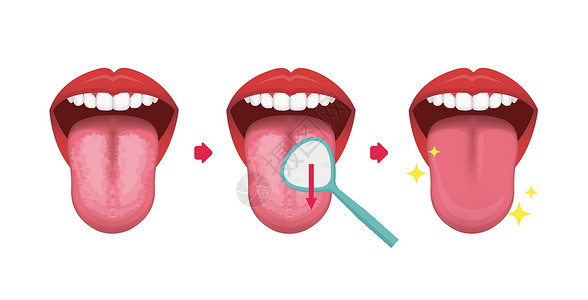 张嘴的女人如何清洁你的舌头矢量插图口臭预防女性牙线牙齿清洁工药品牙医口服福利牙科刮刀插画