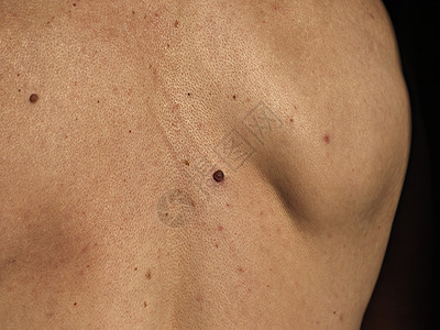 男人皮肤男人背上不断增长的红内奸 皮肤癌症状背景