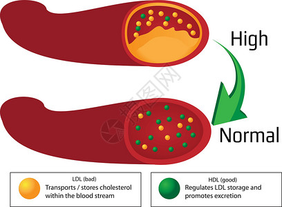 低密度脂蛋白胆固醇将血液容器中高水平的神乐感性塑胶板转化为正常水平插画