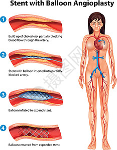 血管支架支架血管成形术动脉细胞药品动脉粥样硬化手术医生内皮科学牌匾心脏病插画