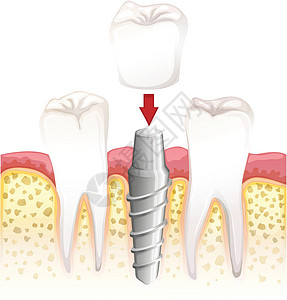 牙冠手术铸件草图程序牙齿科学口服医疗图表金属意义高清图片