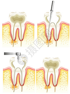 显微根管治疗根管治疗插画