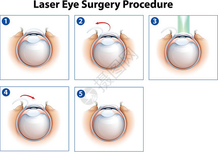 屈光的激光眼科手术程序插画
