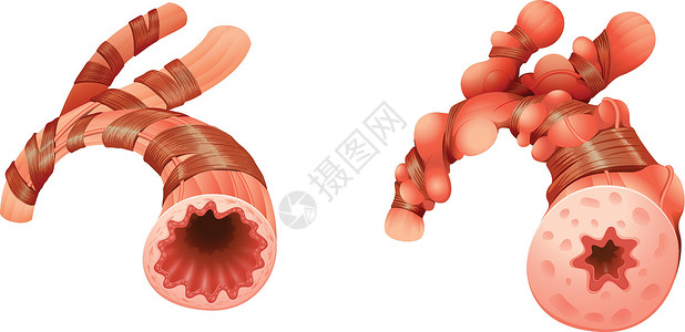 可逆的哮喘喘息封锁支气管空气梗阻疾病气道过敏胸部症状插画