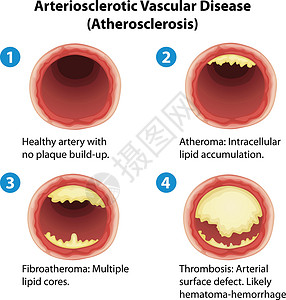 动脉硬化静脉血管动脉艺术插图心脏病硬化积累致命牌匾背景图片