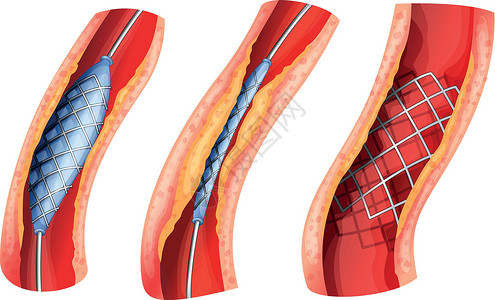 动脉粥样硬化用于打开阻塞动脉的支架插画