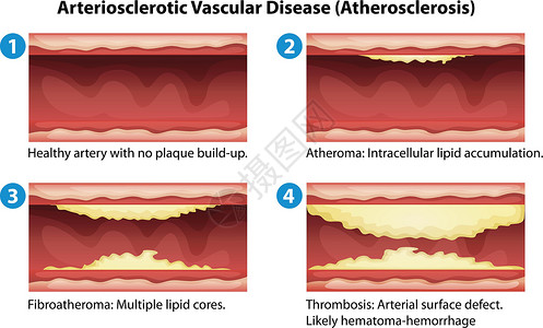 他汀类药物动脉硬化动脉血管支架攻击牌匾组织插图死亡疾病艺术插画