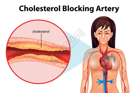 血管栓塞动脉硬化疾病插图细胞致命组织导管牌匾硬化血管死亡插画