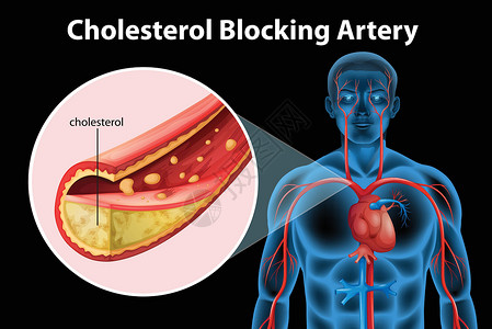 低密度脂蛋白胆固醇动脉硬化致命内皮组织插图动脉粥样硬化心脏病牌匾细胞静脉硬化插画