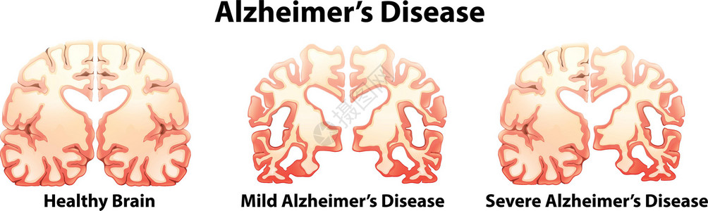阿兹海默症阿尔茨海默氏病困惑科学思维记忆侵略能力大脑情绪绘画压力设计图片