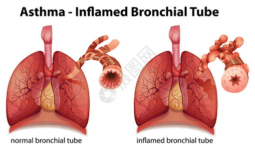哮喘管道科学绳索胸部插图解剖学生物学组织器官生物背景图片