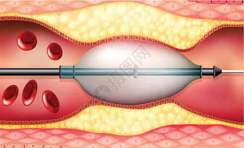 血管成形术线纹流动支架教育医疗管子通道疾病覆膜绘画科学插画