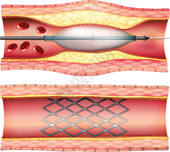 血管成形术心脏病专家局部麻醉高清图片