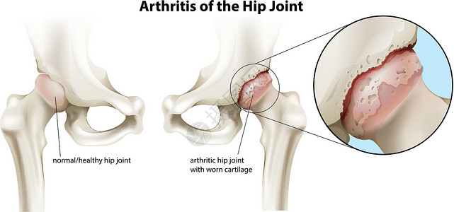 软骨磨损髋关节关节炎炎症压力习惯性磨损滑液表面关节绘画创伤滑膜插画